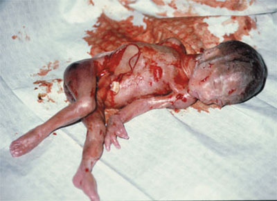 abortedbaby05.jpg