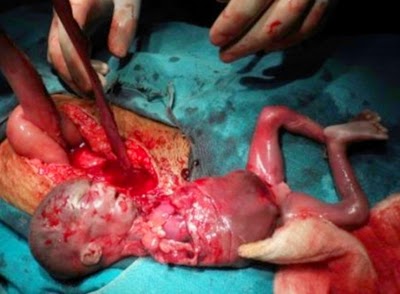 abortedbaby24weeks.jpg